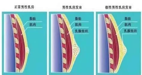 男生 胸|男性乳腺发育症的自我简易判断